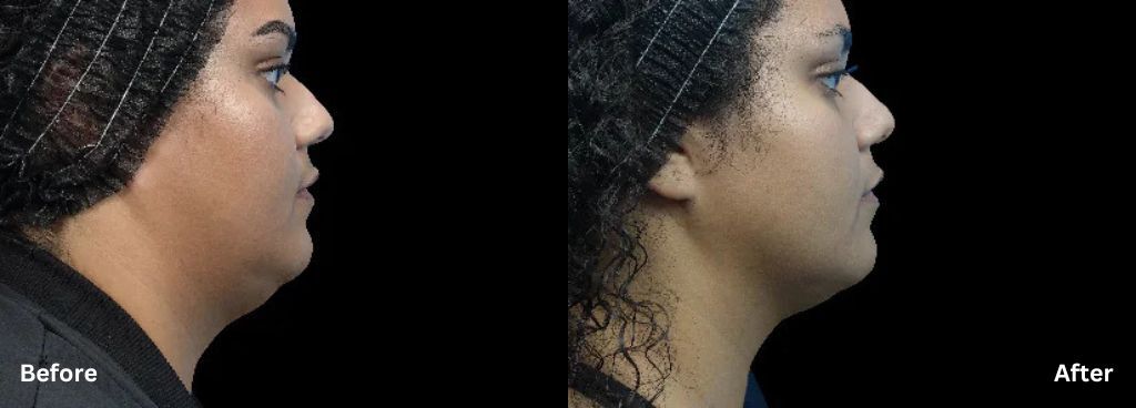 Emface Submentum before and after photos of a woman showing a reduced double-chin appearance.