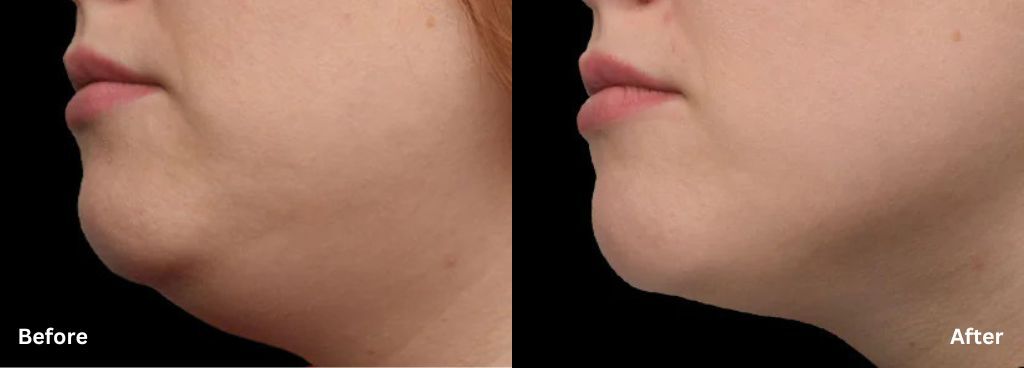 Emface Submentum before and after photos of a woman showing a reduced double-chin appearance.