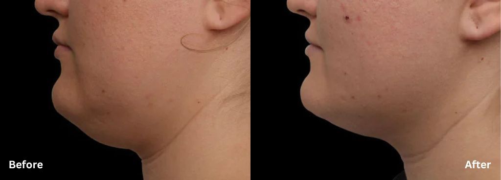 Emface Submentum before and after photos of a woman showing a reduced double-chin appearance.